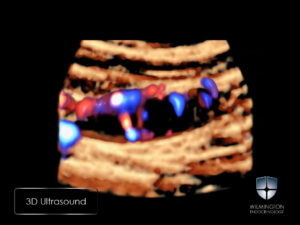 Diagnosis of Parathyroid Adenomas with New Ultrasound Imaging Modalities